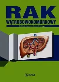 Rak wątrobowokomórkowy Rak wątrobowokomórkowy